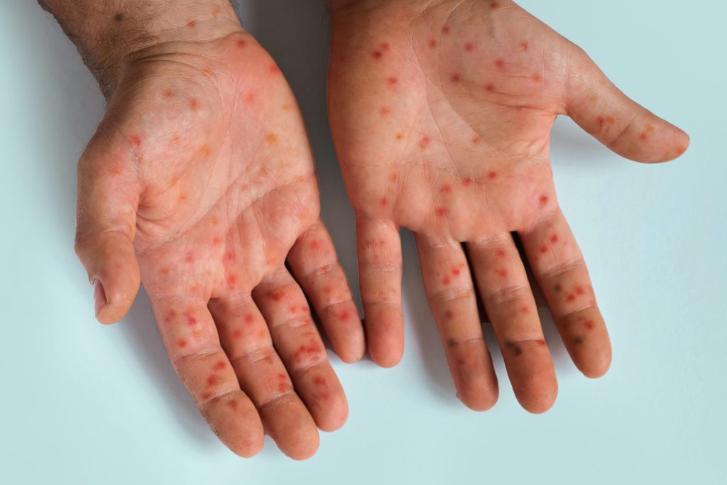outh Africa is managing two vaccine-preventable outbreaks, with mpox cases rising sharply in recent weeks while a diphtheria outbreak continues at a slower pace.