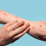 outh Africa is managing two vaccine-preventable outbreaks, with mpox cases rising sharply in recent weeks while a diphtheria outbreak continues at a slower pace.