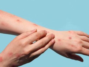 outh Africa is managing two vaccine-preventable outbreaks, with mpox cases rising sharply in recent weeks while a diphtheria outbreak continues at a slower pace.